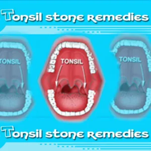 How to Treat Pus on Tonsils?