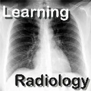 Video Podcast 55-Pulmonary Sarcoid-Radiographic Manifestations